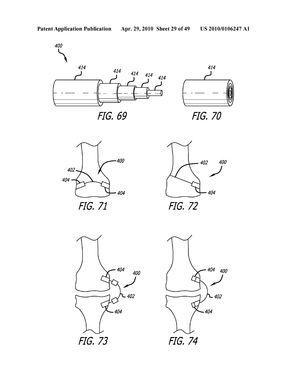 Extra-Articular Implantable Mechanical Energy Absorbing Systems - diagram, schematic, and image 30