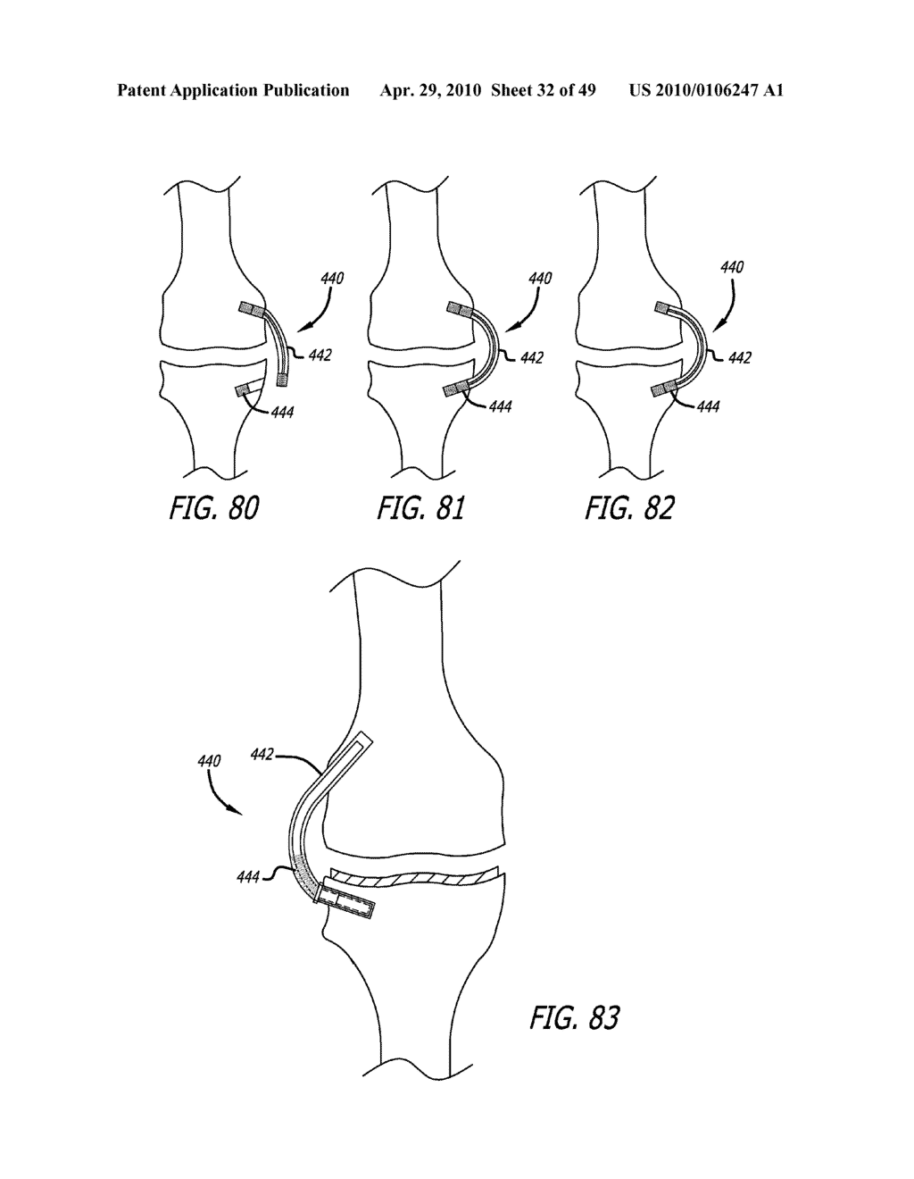 Extra-Articular Implantable Mechanical Energy Absorbing Systems - diagram, schematic, and image 33