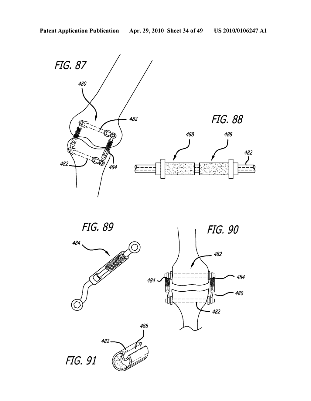 Extra-Articular Implantable Mechanical Energy Absorbing Systems - diagram, schematic, and image 35