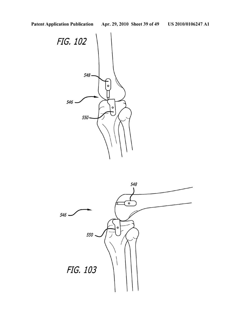 Extra-Articular Implantable Mechanical Energy Absorbing Systems - diagram, schematic, and image 40