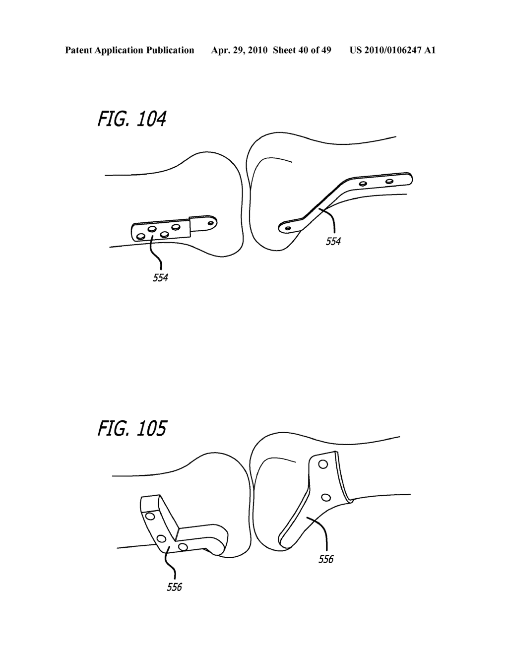 Extra-Articular Implantable Mechanical Energy Absorbing Systems - diagram, schematic, and image 41