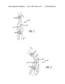 Extra-Articular Implantable Mechanical Energy Absorbing Systems diagram and image