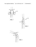 Extra-Articular Implantable Mechanical Energy Absorbing Systems diagram and image