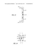 Extra-Articular Implantable Mechanical Energy Absorbing Systems diagram and image