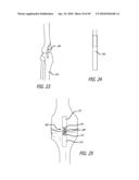 Extra-Articular Implantable Mechanical Energy Absorbing Systems diagram and image