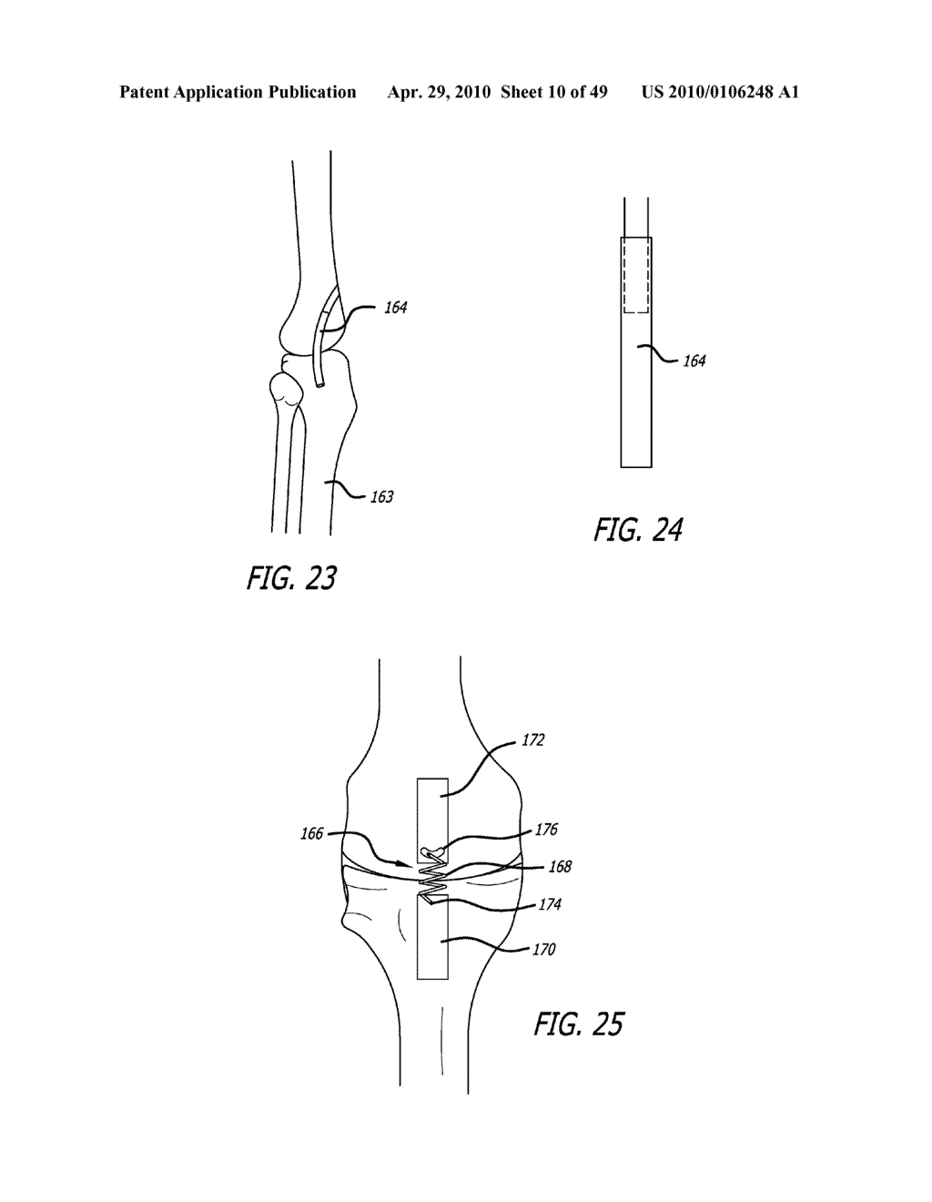 Extra-Articular Implantable Mechanical Energy Absorbing Systems - diagram, schematic, and image 11