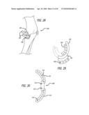 Extra-Articular Implantable Mechanical Energy Absorbing Systems diagram and image