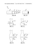 Extra-Articular Implantable Mechanical Energy Absorbing Systems diagram and image