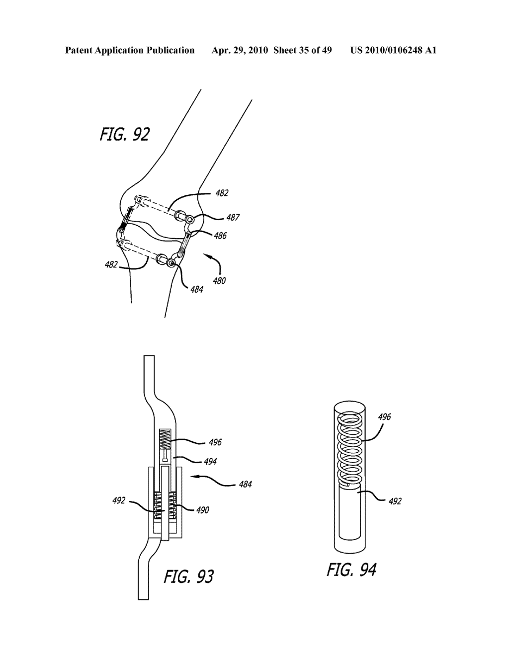 Extra-Articular Implantable Mechanical Energy Absorbing Systems - diagram, schematic, and image 36