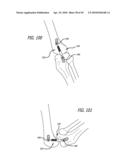 Extra-Articular Implantable Mechanical Energy Absorbing Systems diagram and image