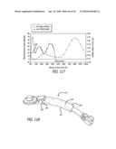 Extra-Articular Implantable Mechanical Energy Absorbing Systems diagram and image