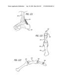 Extra-Articular Implantable Mechanical Energy Absorbing Systems diagram and image