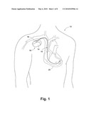 Multi-Layer Miniature Antenna For Implantable Medical Devices and Method for Forming the Same diagram and image