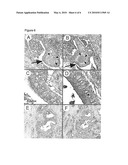 IL-4 RECEPTOR AND IL-13 AS PROGNOSTIC MARKERS FOR COLON AND PANCREAS TUMORS diagram and image