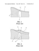 VIBRATIONAL FILLING DEVICE FOR IMPLANTING TOOTH BONE POWDER diagram and image