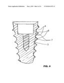 CONDENSING SKELETAL IMPLANT THAT FACILITATE INSERTIONS diagram and image