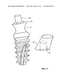 CONDENSING SKELETAL IMPLANT THAT FACILITATE INSERTIONS diagram and image