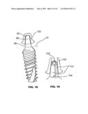 CONDENSING SKELETAL IMPLANT THAT FACILITATE INSERTIONS diagram and image