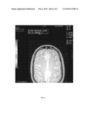 HIGH DOSE GLYCINE AS A TREATMENT FOR OBSESSIVE-COMPULSIVE DISORDER AND OBSESSIVE COMPULSIVE SPECTRUM DISORDERS diagram and image