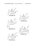 SYSTEMS AND METHODS FOR TREATING ANTERIOR PELVIC ORGAN PROLAPSE diagram and image