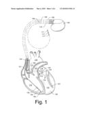 INTERPOLATING LEFT VENTRICULAR PRESSURES diagram and image