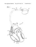 DETERMINING INTERCARDIAC IMPEDANCE diagram and image