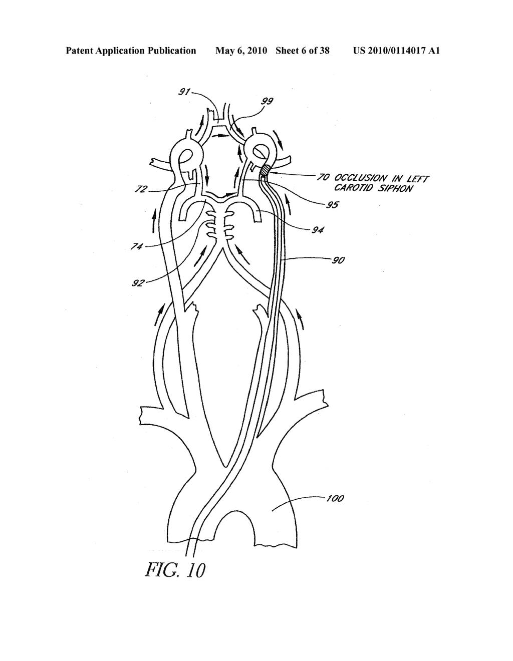 SYSTEMS AND METHODS FOR REMOVING OBSTRUCTIVE MATTER FROM BODY LUMENS AND TREATING VASCULAR DEFECTS - diagram, schematic, and image 07