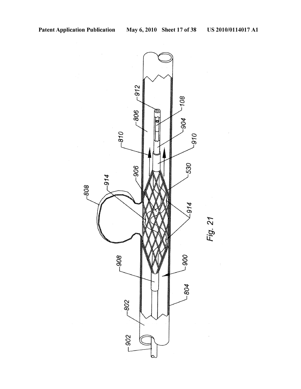 SYSTEMS AND METHODS FOR REMOVING OBSTRUCTIVE MATTER FROM BODY LUMENS AND TREATING VASCULAR DEFECTS - diagram, schematic, and image 18