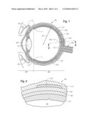 Juxtascleral drug delivery and ocular implant system diagram and image