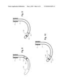 Juxtascleral drug delivery and ocular implant system diagram and image