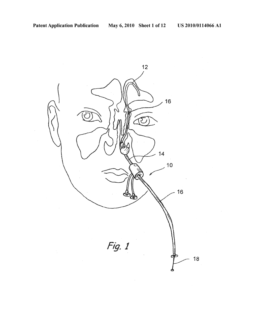 IMPLANTABLE DEVICES AND METHODS FOR DELIVERING DRUGS AND OTHER SUBSTANCES TO TREAT SINUSITIS AND OTHER DISORDERS - diagram, schematic, and image 02