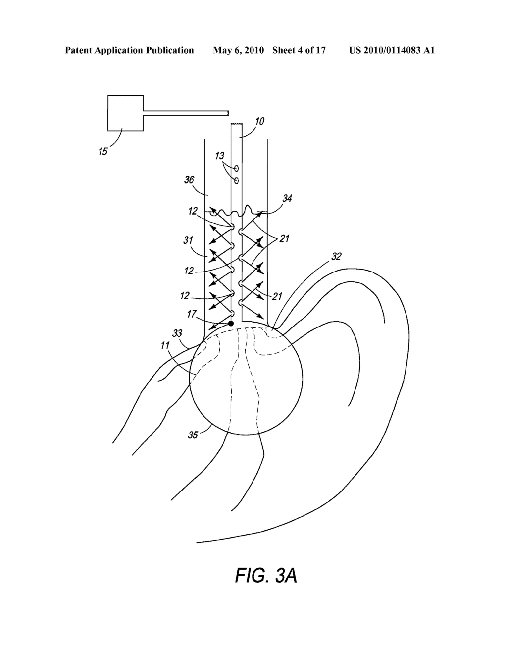 Method and Apparatus for the Ablation of Gastrointestinal Tissue - diagram, schematic, and image 05