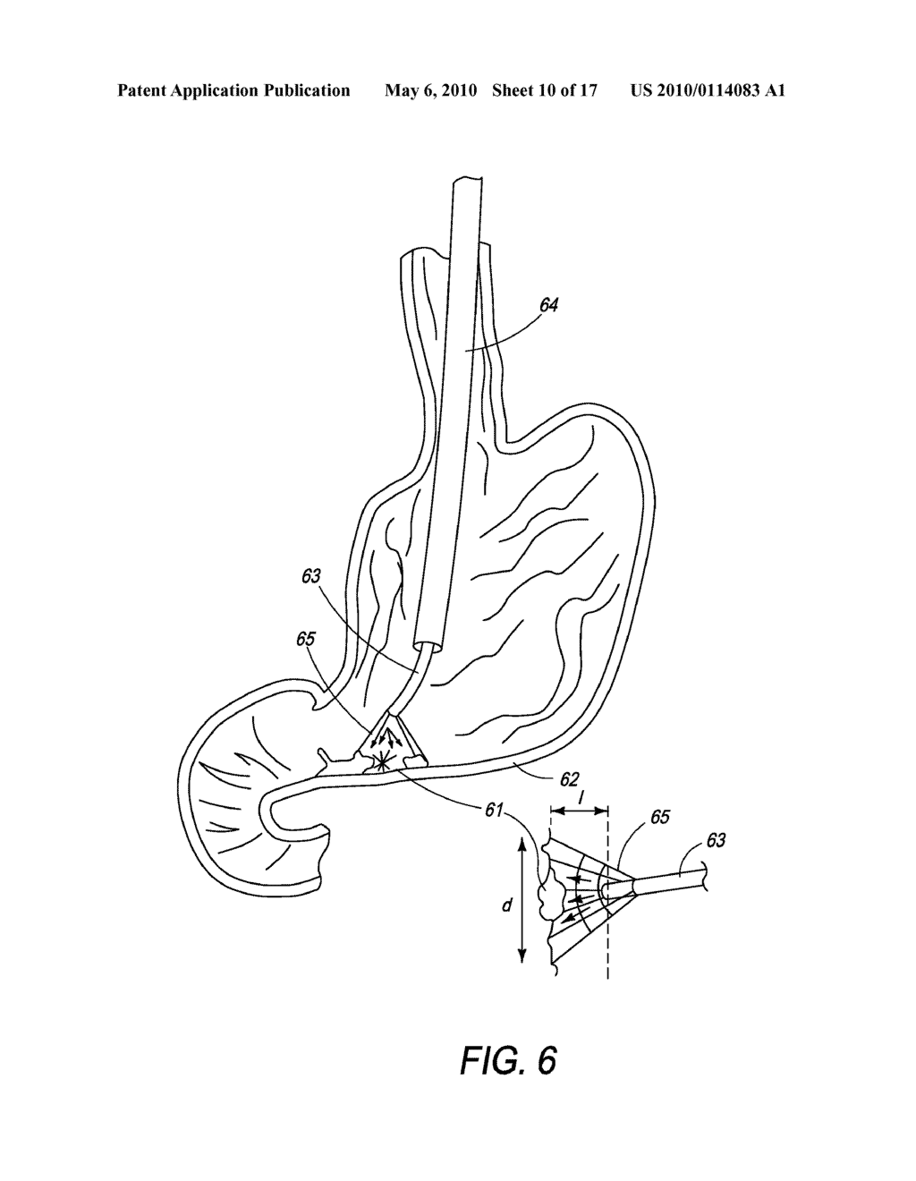 Method and Apparatus for the Ablation of Gastrointestinal Tissue - diagram, schematic, and image 11