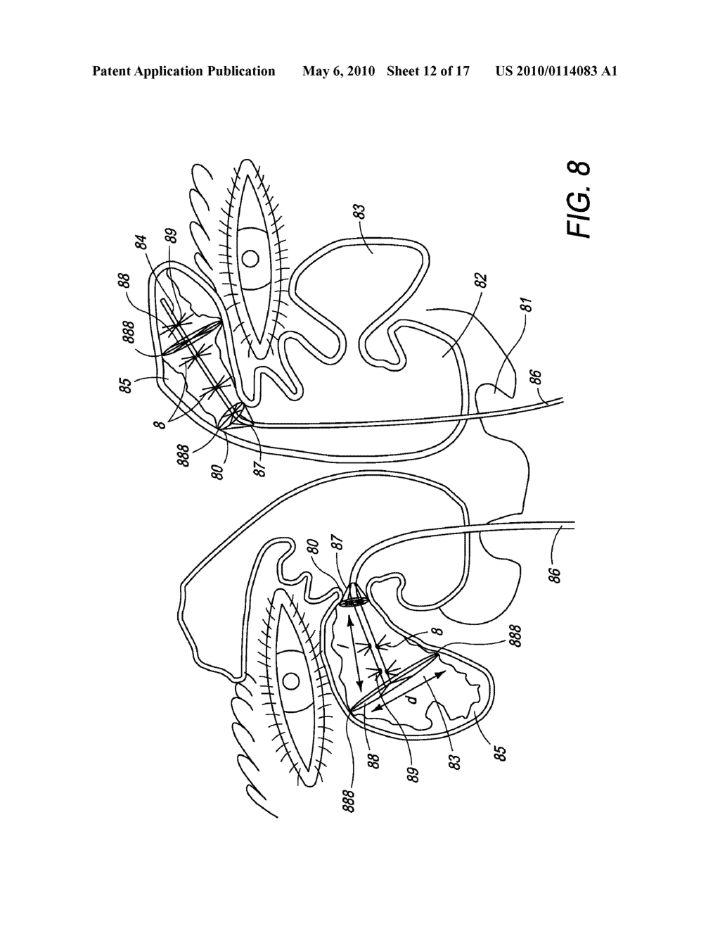 Method and Apparatus for the Ablation of Gastrointestinal Tissue - diagram, schematic, and image 13