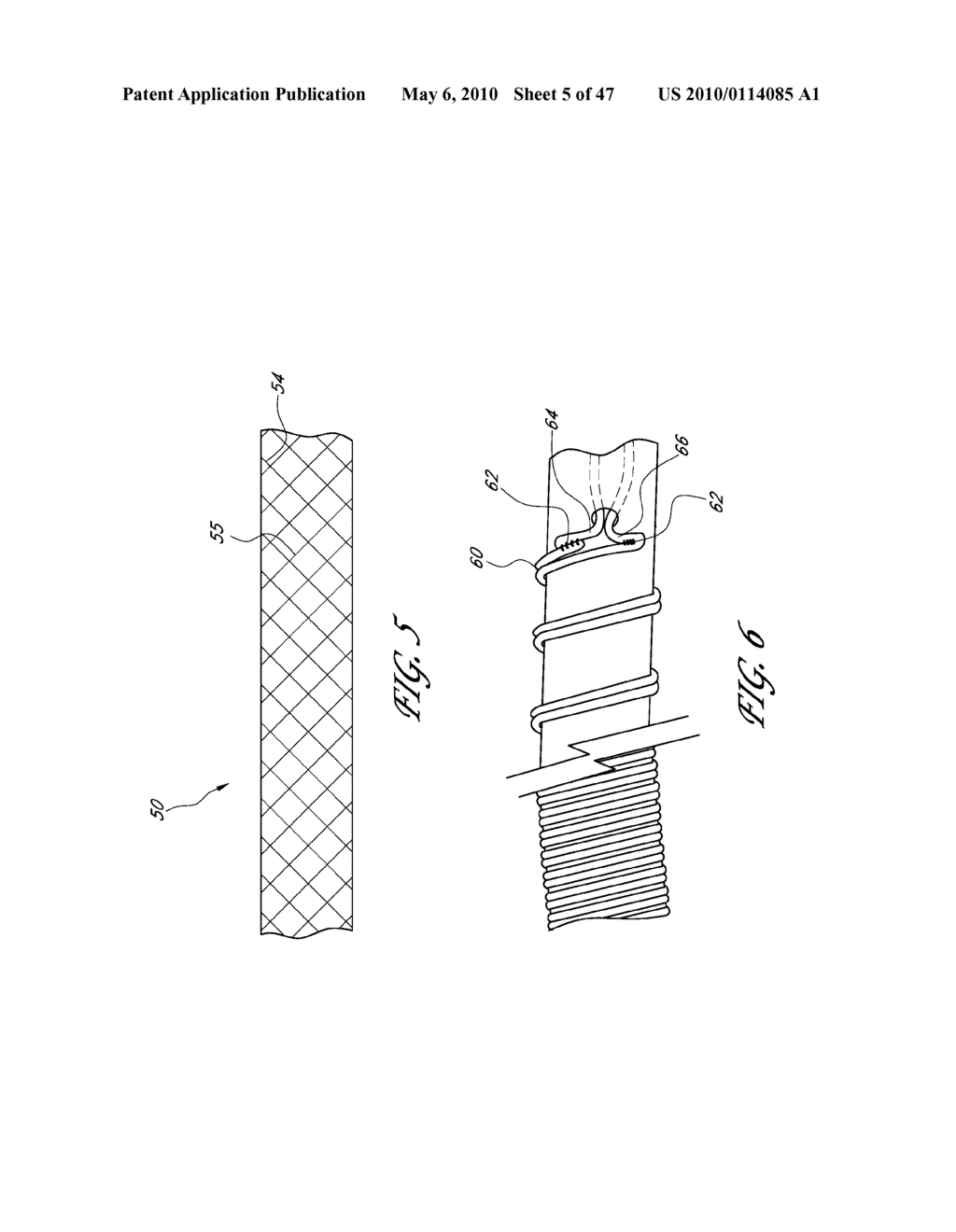 METHODS FOR TREATING A HOLLOW ANATOMICAL STRUCTURE - diagram, schematic, and image 06