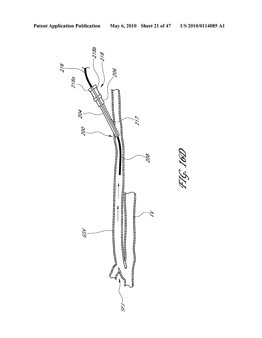 METHODS FOR TREATING A HOLLOW ANATOMICAL STRUCTURE - diagram, schematic, and image 22