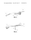 Implant Devices Constructed with Metallic and Polymeric Components diagram and image