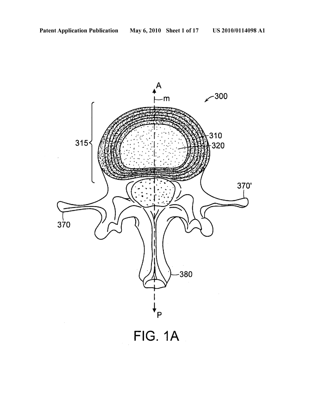 DEVICES AND METHODS FOR STABILIZING A SPINAL REGION - diagram, schematic, and image 02