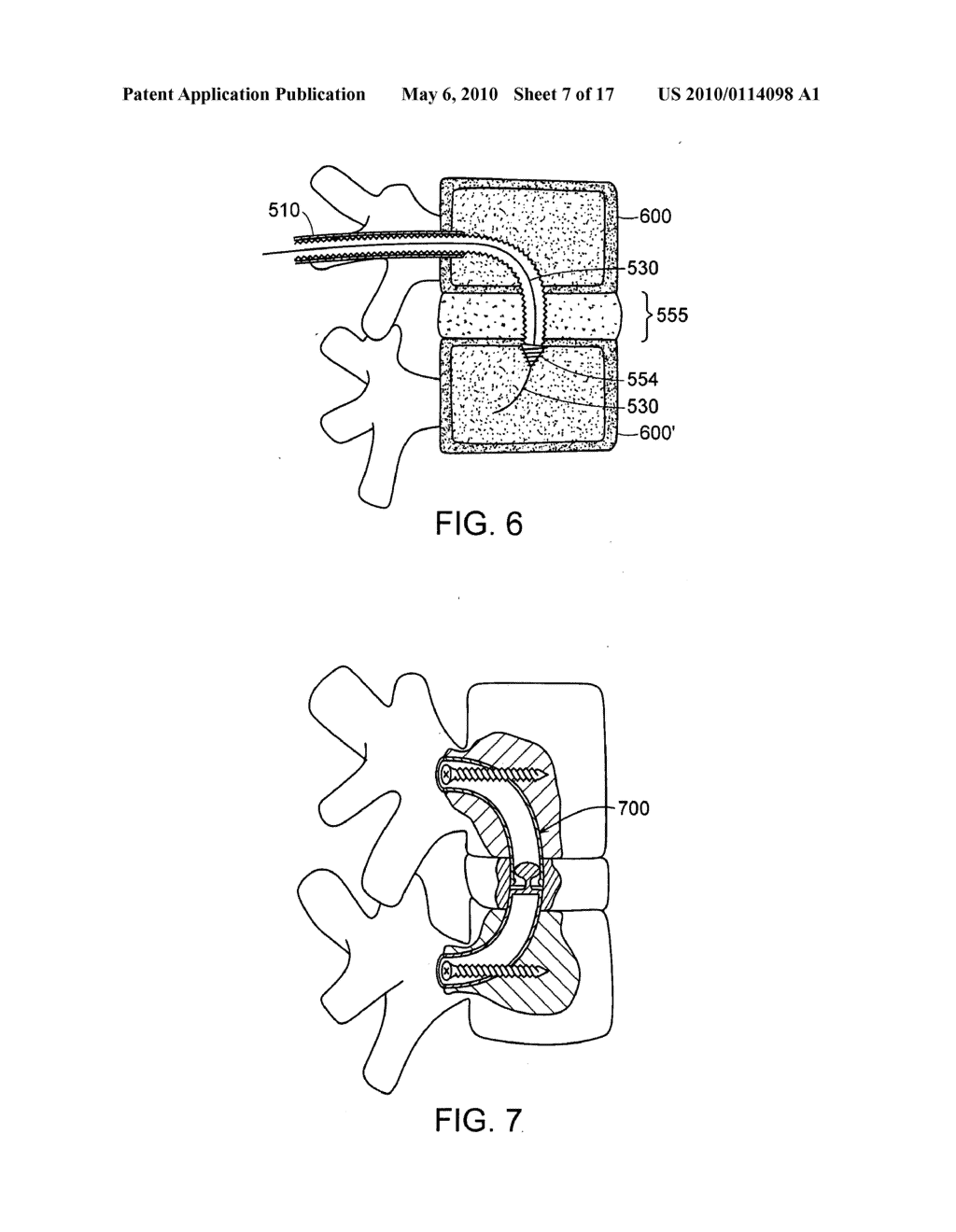 DEVICES AND METHODS FOR STABILIZING A SPINAL REGION - diagram, schematic, and image 08