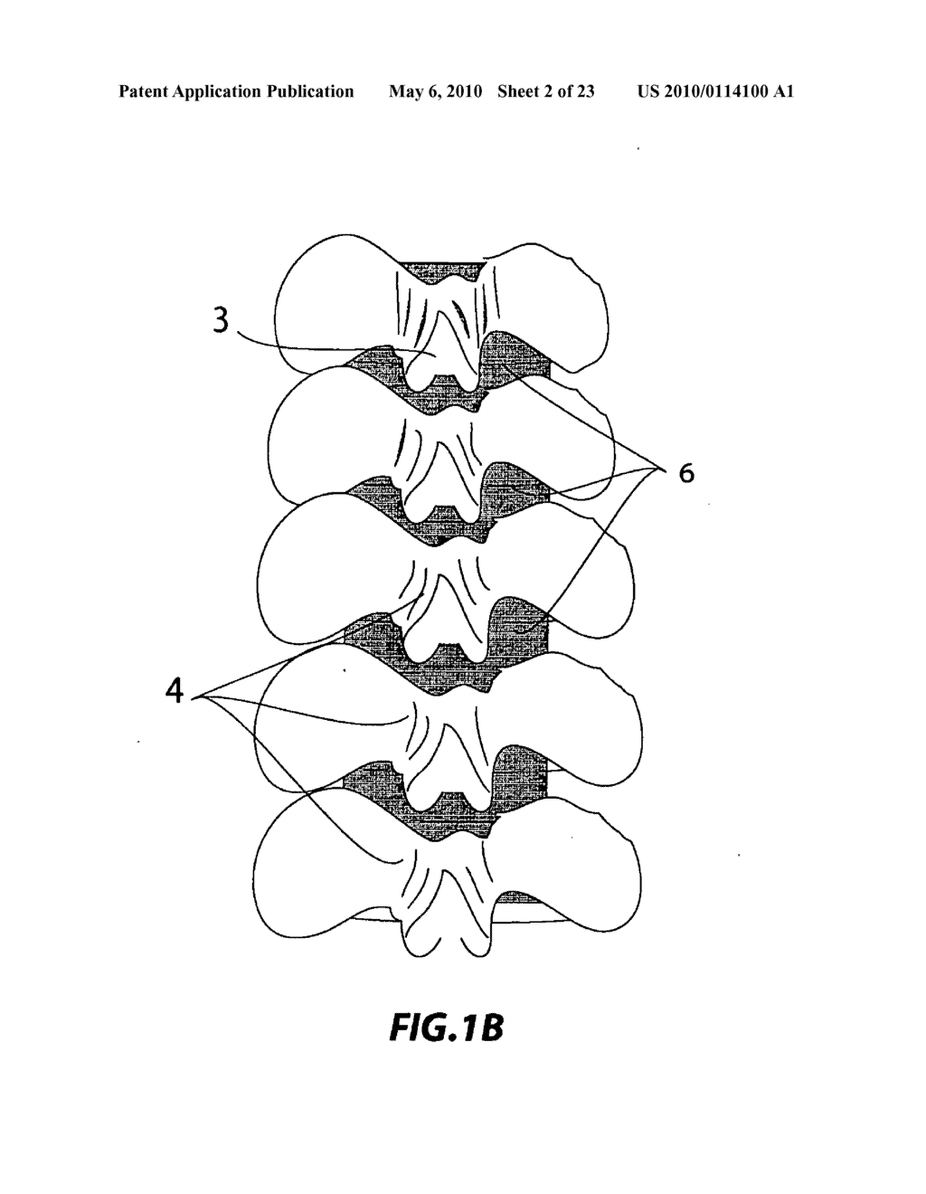 TECHNIQUE AND DEVICE FOR LAMINAR OSTEOTOMY AND LAMINOPLASTY - diagram, schematic, and image 03