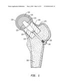 METHOD OF RESECTING A FEMORAL HEAD FOR IMPLANTATION OF A FEMORAL NECK FIXATION PROSTHESIS diagram and image