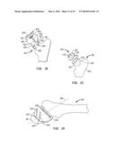 METHOD OF RESECTING A FEMORAL HEAD FOR IMPLANTATION OF A FEMORAL NECK FIXATION PROSTHESIS diagram and image