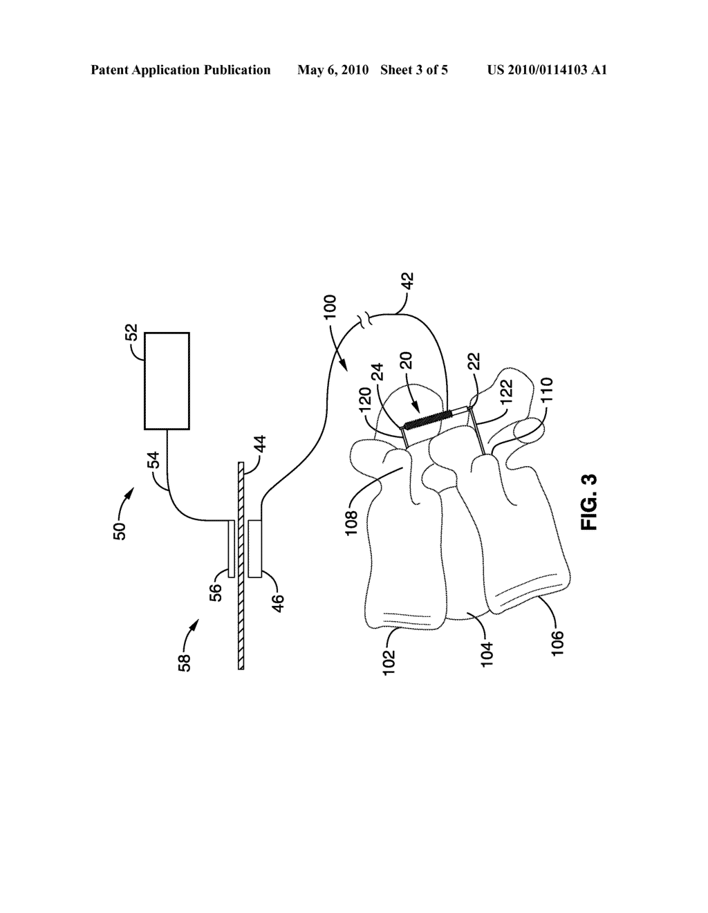 APPARATUS AND METHODS FOR ALTERATION OF ANATOMICAL FEATURES - diagram, schematic, and image 04