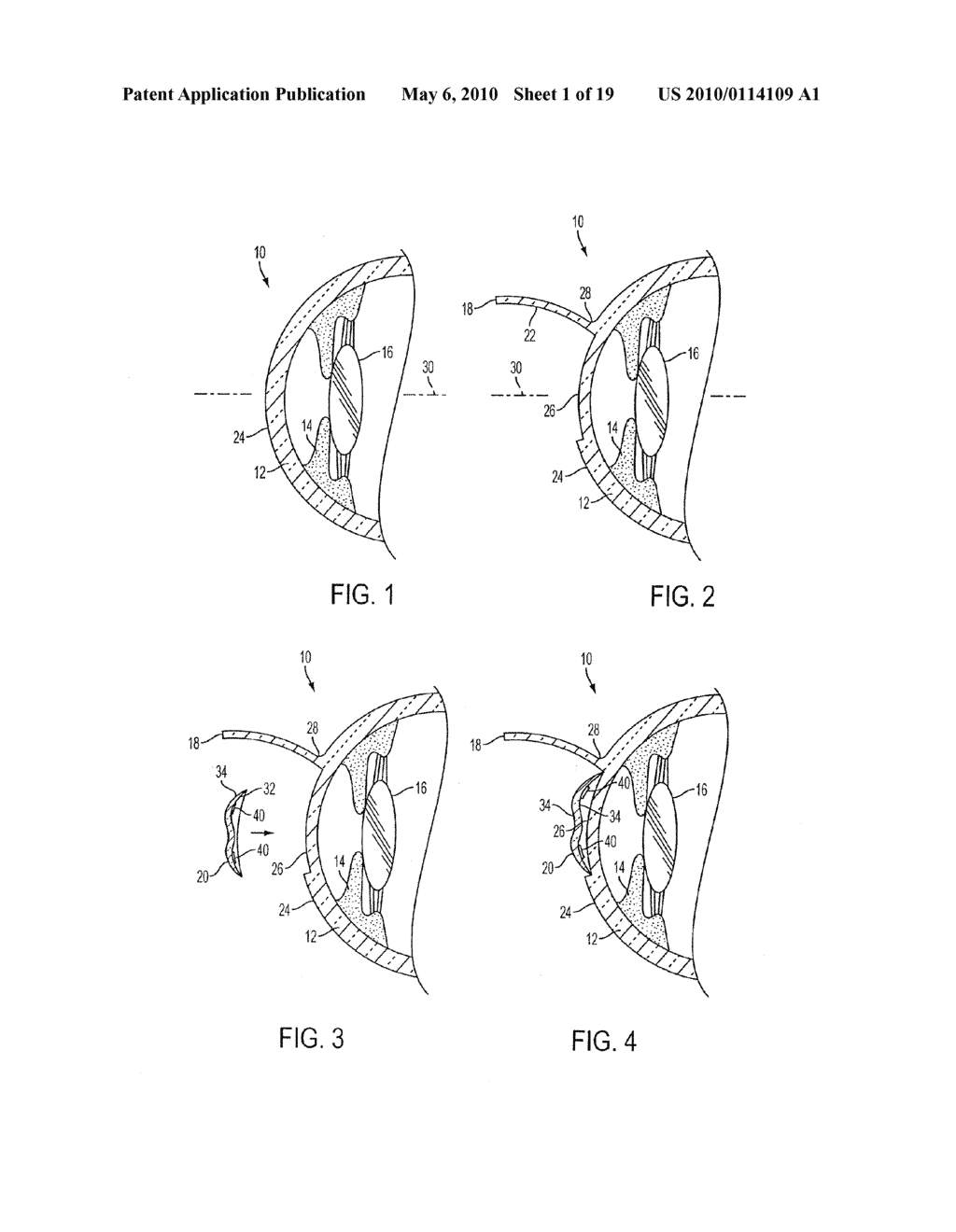 METHOD FOR PREVENTION OF REJECTION AND SEVER ENCAPSULATION OF A SUPPORTIVE OR FUNCTIONING IMPLANT - diagram, schematic, and image 02