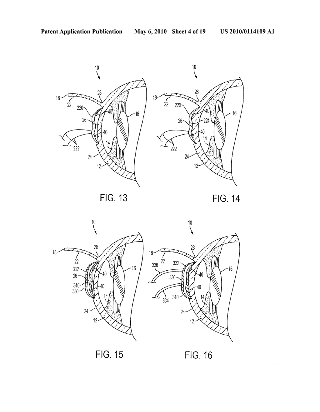 METHOD FOR PREVENTION OF REJECTION AND SEVER ENCAPSULATION OF A SUPPORTIVE OR FUNCTIONING IMPLANT - diagram, schematic, and image 05