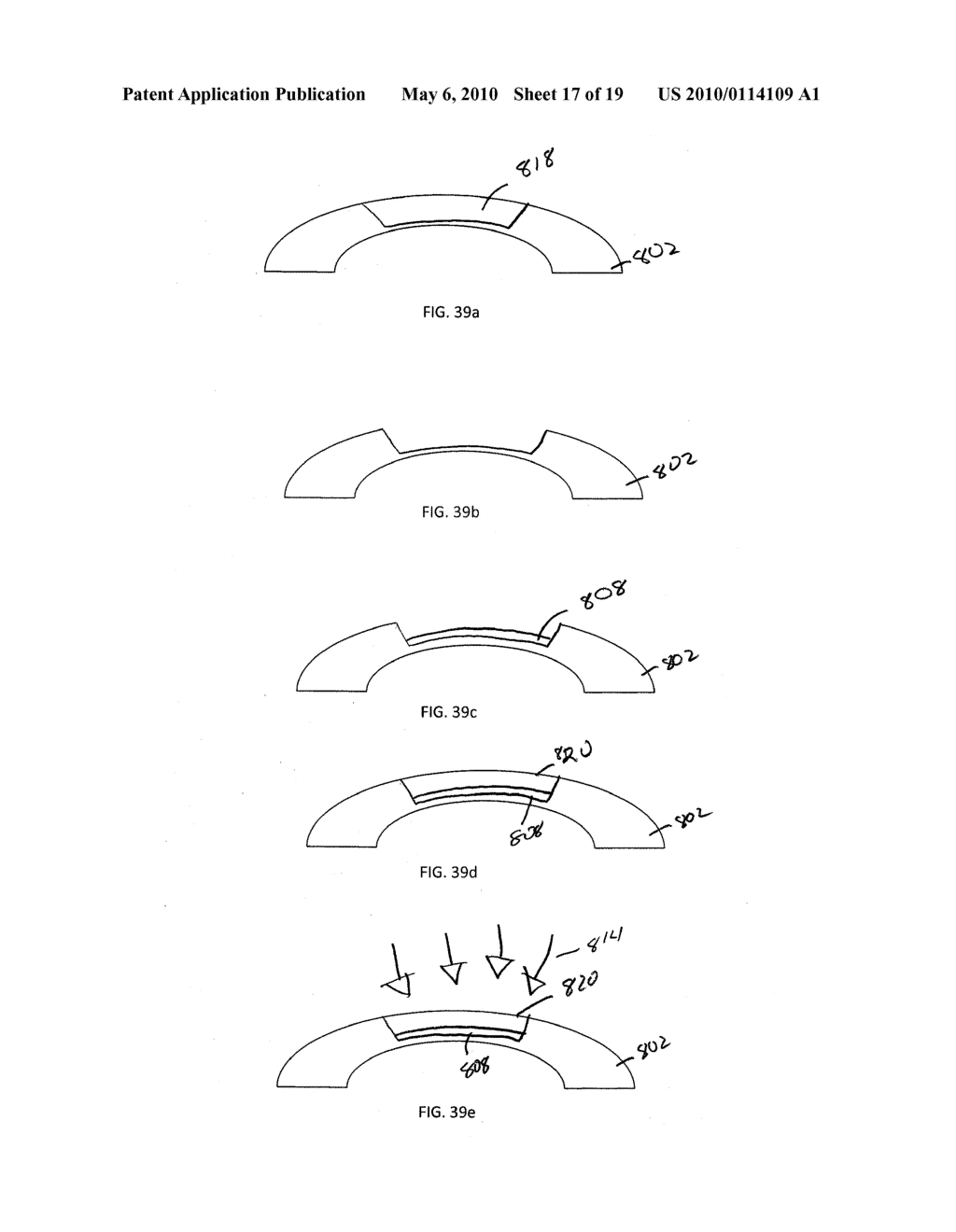 METHOD FOR PREVENTION OF REJECTION AND SEVER ENCAPSULATION OF A SUPPORTIVE OR FUNCTIONING IMPLANT - diagram, schematic, and image 18