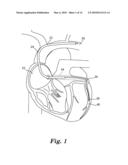 CORONARY VEIN NAVIGATOR diagram and image