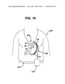 DEVICES AND METHODS FOR ADJUSTING A SATIATION AND SATIETY-INDUCING IMPLANTED DEVICE diagram and image