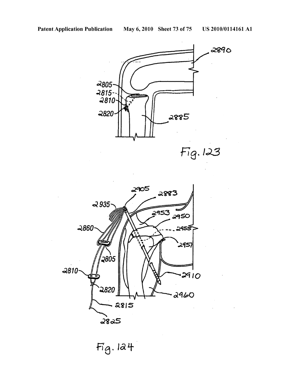 Apparatus for Tissue Repair - diagram, schematic, and image 74