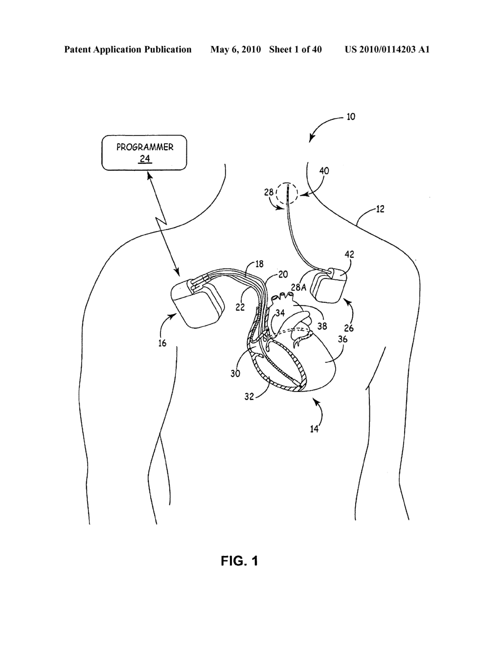 IMPLANTABLE MEDICAL DEVICE CROSSTALK EVALUATION AND MITIGATION - diagram, schematic, and image 02